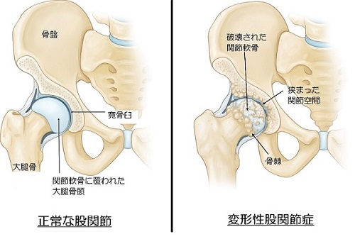 「変形性股関節症 寛骨臼」の画像検索結果