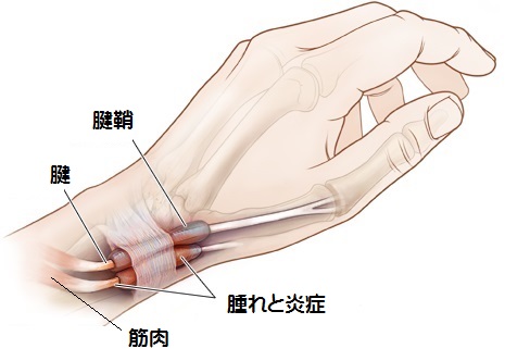 腱鞘炎